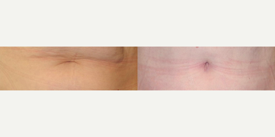 Case 18 - Woman treated with Tummy Tuck