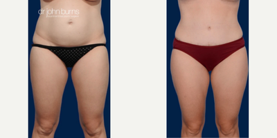 Case 180 - Woman treated with Tummy Tuck