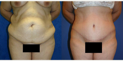 Case 1800 - Woman treated with Tummy Tuck
