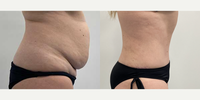 Case 1801 - 35-44 year old woman treated with Tummy Tuck