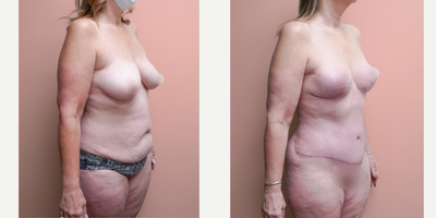 Case 1802 - 45-54 year old woman treated with Tummy Tuck, Liposuction, Breast Lift, Mommy Makeover
