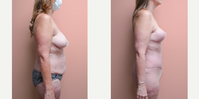 Case 1803 - 45-54 year old woman treated with Tummy Tuck, Liposuction, Breast Lift, Mommy Makeover