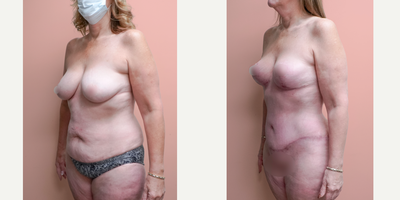 Case 1804 - 45-54 year old woman treated with Tummy Tuck