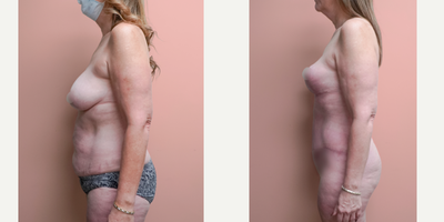 Case 1805 - 45-54 year old woman treated with Tummy Tuck