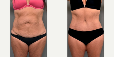 Case 1814 - Woman treated with Tummy Tuck