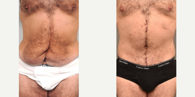 Case 1815 - Man treated with Tummy Tuck