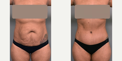 Case 1816 - Woman treated with Tummy Tuck