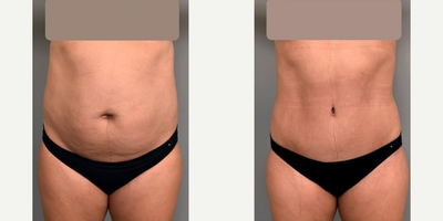 Case 1817 - Woman treated with Tummy Tuck