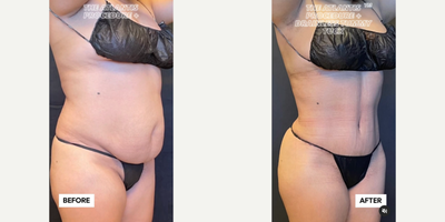 Case 1818 - Woman treated with Tummy Tuck