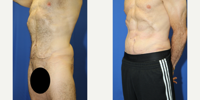 Case 1819 - 45-54 year old man treated with Tummy Tuck