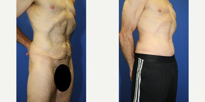 Case 1820 - 45-54 year old man treated with Tummy Tuck