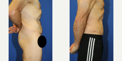 Case 1821 - 45-54 year old man treated with Tummy Tuck