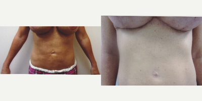 Case 1823 - 35-44 year old woman treated with Breast Implant Revision