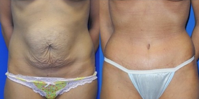Case 1826 - Tummy Tuck
