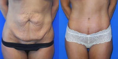 Case 1827 - Tummy Tuck