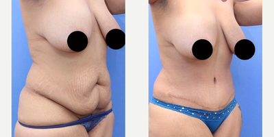 Case 1828 - Woman treated with Tummy Tuck, Liposuction