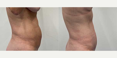 Case 1830 - 45-54 year old woman treated with Tummy Tuck