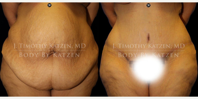 Case 1831 - Woman treated with Tummy Tuck