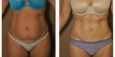 Case 1832 - Woman treated with Tummy Tuck