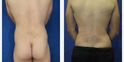 Case 1833 - 35-44 year old man treated with Tummy Tuck