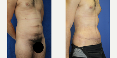 Case 1834 - 35-44 year old man treated with Tummy Tuck