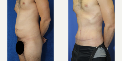 Case 1835 - 35-44 year old man treated with Tummy Tuck