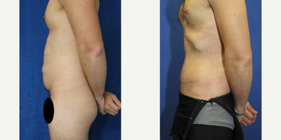 Case 1836 - 35-44 year old man treated with Tummy Tuck