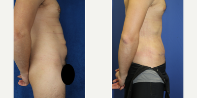 Case 1837 - 35-44 year old man treated with Tummy Tuck