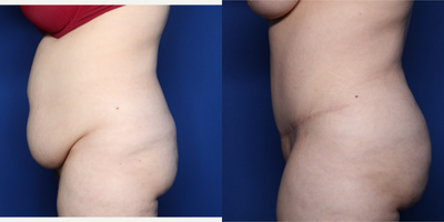 Case 1839 - 25-34 year old woman treated with Tummy Tuck