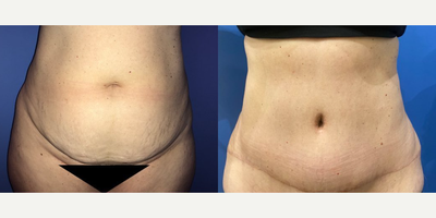 Case 184 - Woman treated with Breast Augmentation