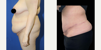 Case 1841 - 25-34 year old woman treated with Tummy Tuck