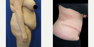 Case 1842 - 25-34 year old woman treated with Tummy Tuck