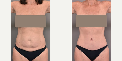 Case 1843 - Woman treated with Tummy Tuck