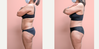 Case 1844 - 35-44 year old woman treated with Tummy Tuck