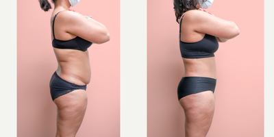 Case 1845 - 35-44 year old woman treated with Tummy Tuck, Liposuction