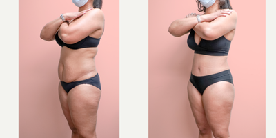 Case 1846 - 35-44 year old woman treated with Tummy Tuck, Liposuction