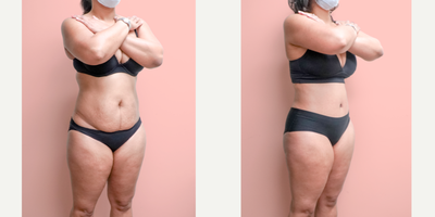 Case 1847 - 35-44 year old woman treated with Tummy Tuck, Liposuction