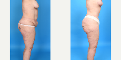 Case 1848 - Woman treated with Tummy Tuck