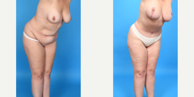 Case 1849 - Woman treated with Tummy Tuck