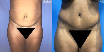 Case 185 - Woman treated with Tummy Tuck