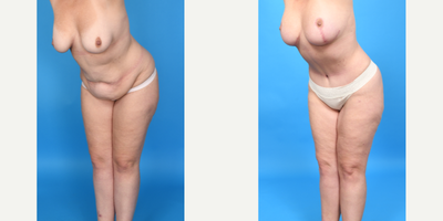 Case 1850 - Woman treated with Tummy Tuck