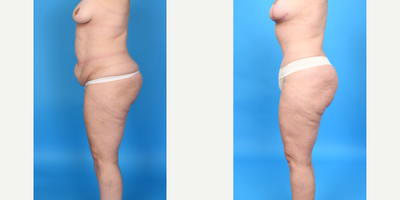 Case 1851 - Woman treated with Tummy Tuck