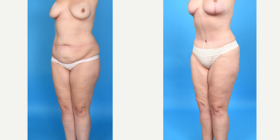 Case 1852 - Woman treated with Tummy Tuck