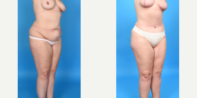 Case 1853 - Woman treated with Tummy Tuck