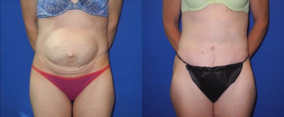 Case 1855 - Woman treated with Tummy Tuck