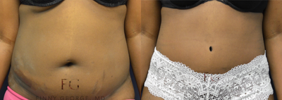 Case 1856 - 25-34 year old woman treated with Tummy Tuck