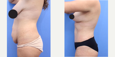 Case 1857 - Breast Lift, Tummy Tuck, Liposuction