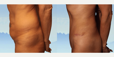 Case 1858 - Tummy Tuck