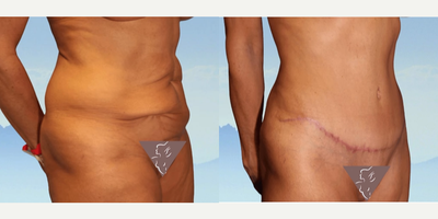 Case 1859 - Tummy Tuck