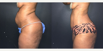 Case 1860 - Woman treated with Tummy Tuck